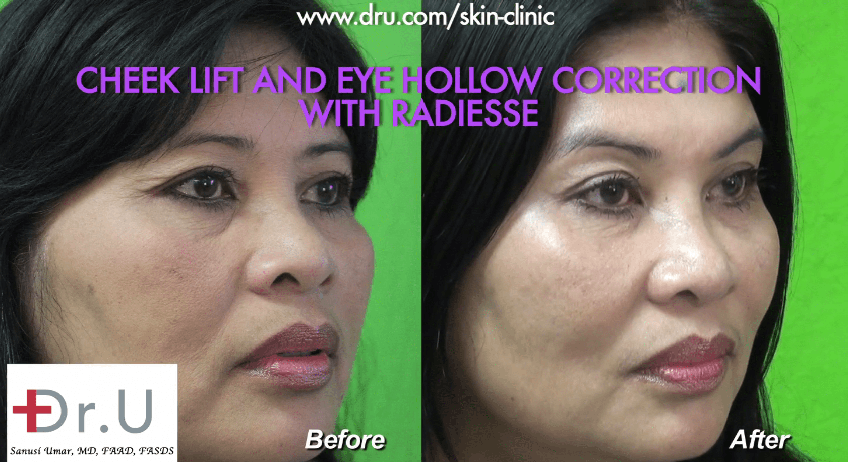 The patient before and after Dr. U performed a non surgical cheek lift and hollow eye treatment using Radiesse.*