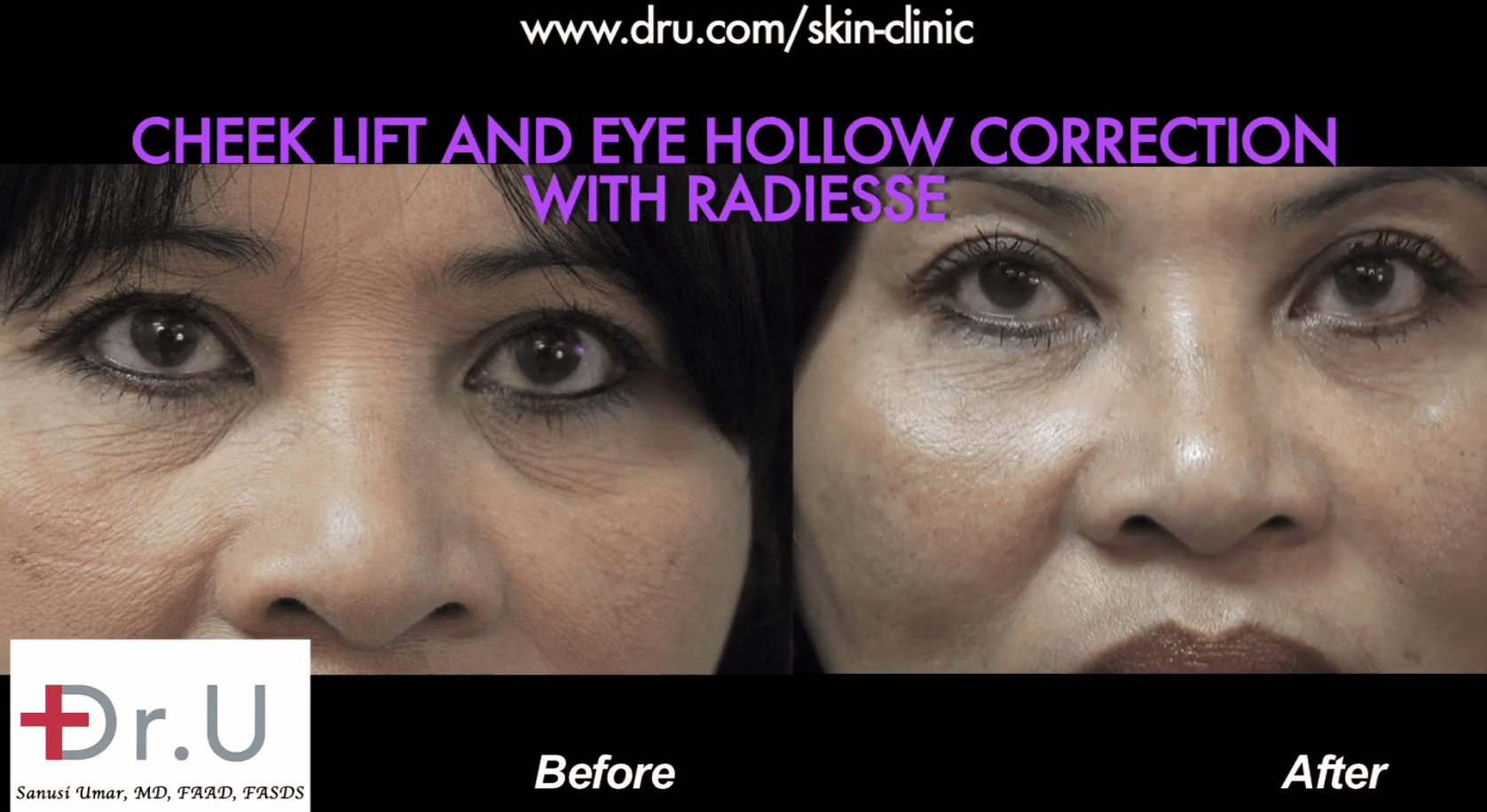 Under eye hollow filler before and after photos using Radiesse.* 