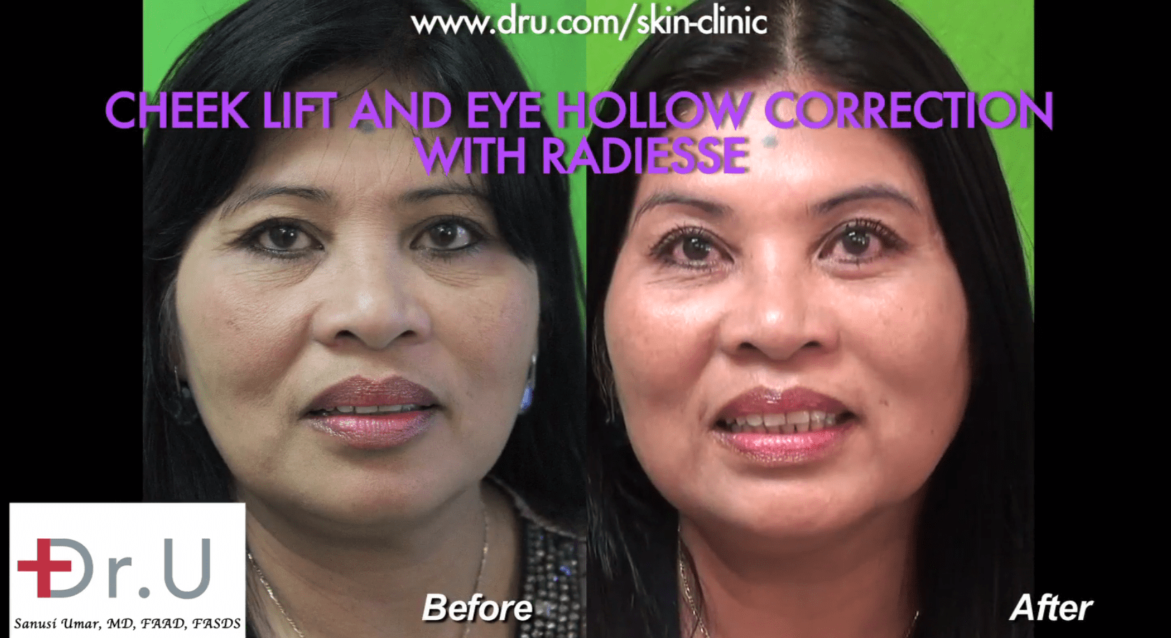 Before and after the patient's non surgical cheek lift and hollow eye treatment.*