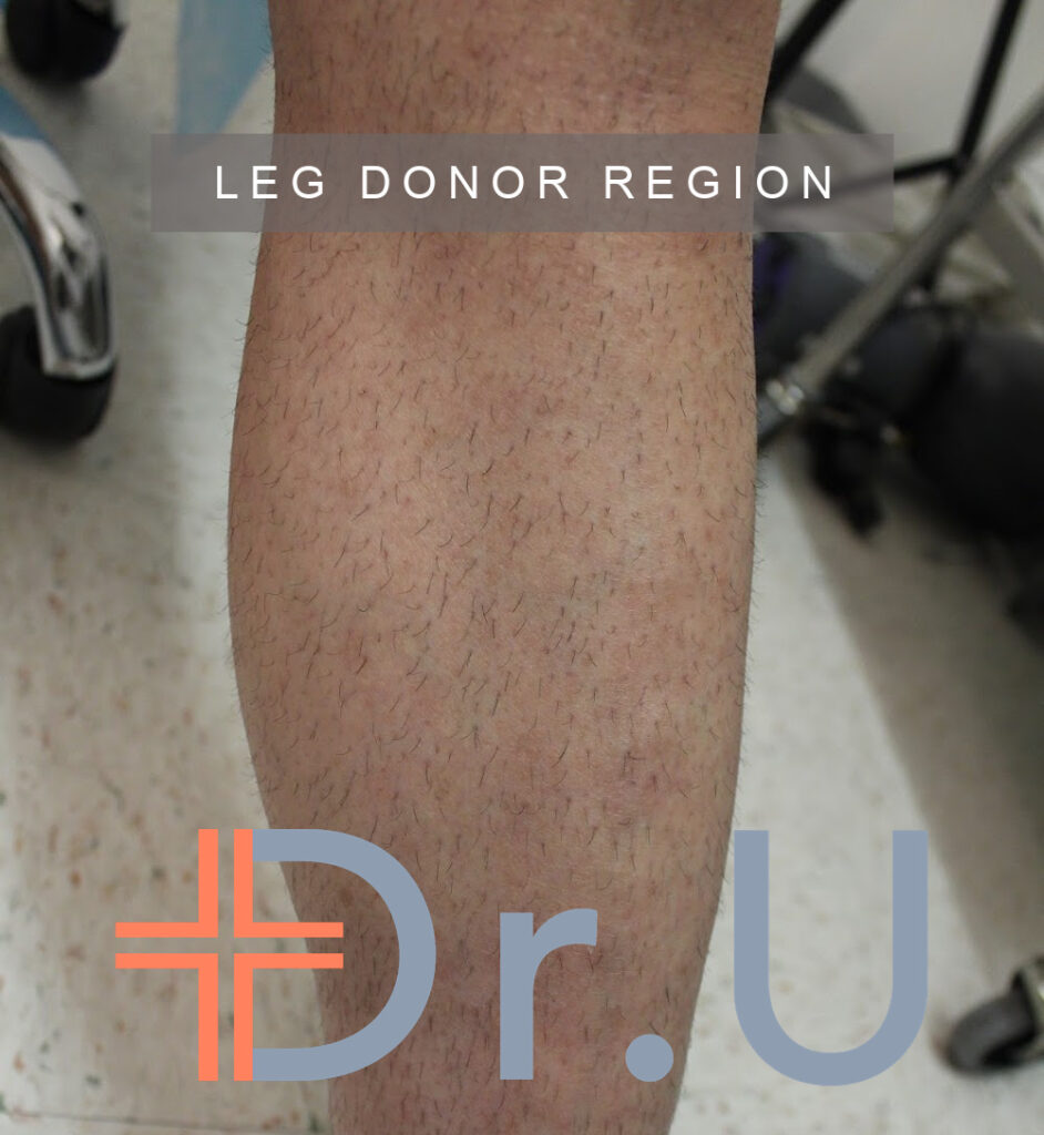 Leg donor area used for body hair transplant patient