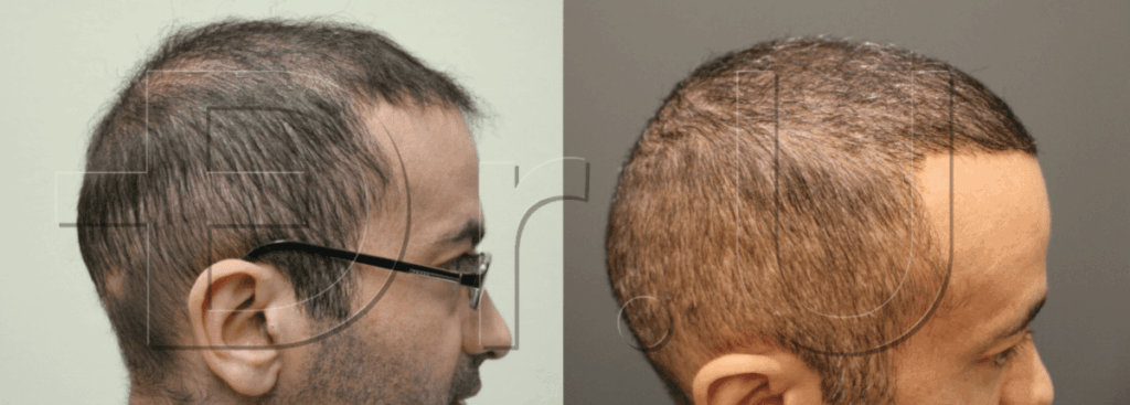 Side profile view of patient’s hair restoration repair using both body and scalp hair *