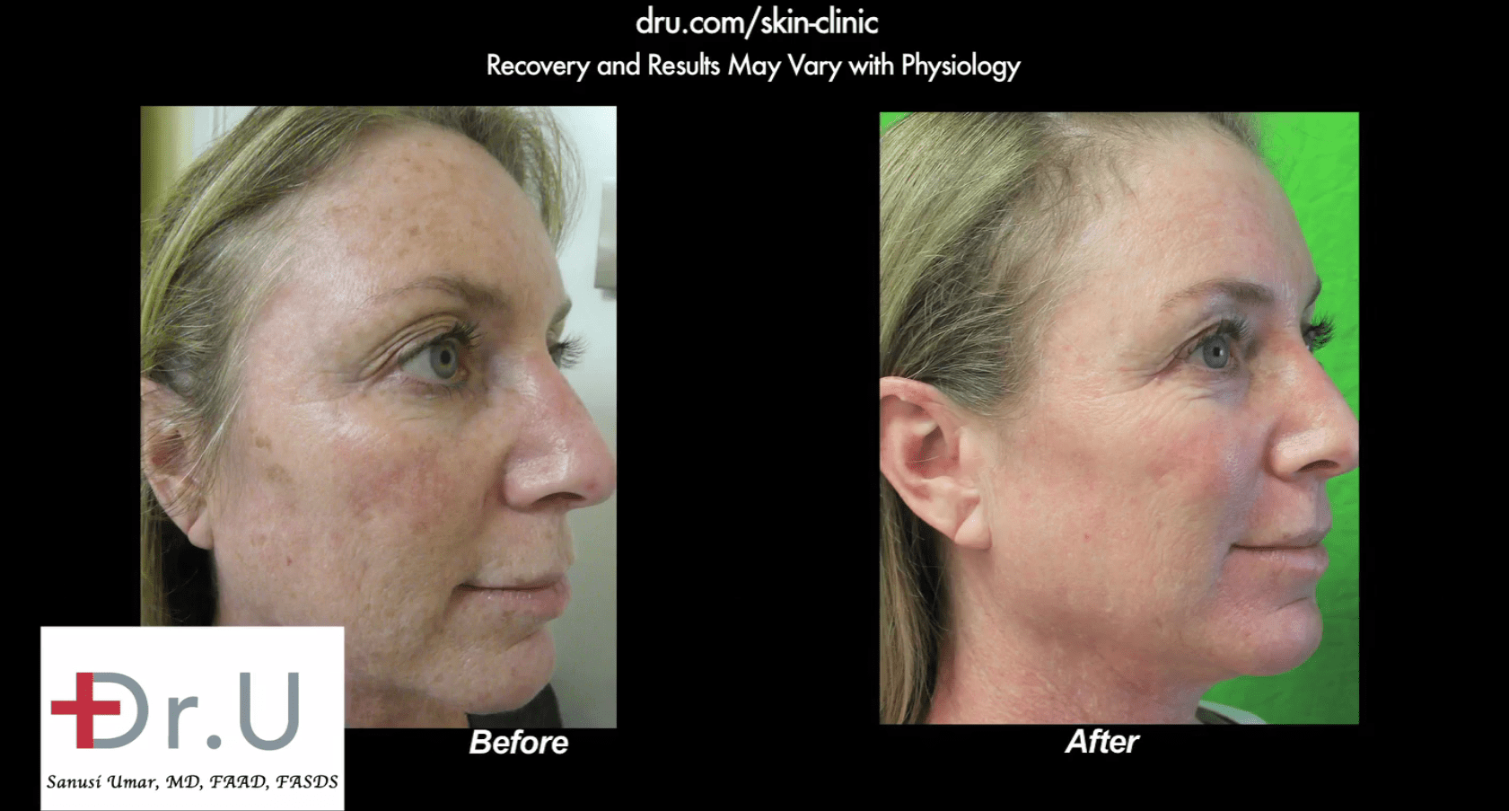 Spectra laser before and after only one session results in dramatic improvement.* Spectra laser before and after only one session results in dramatic improvement.*