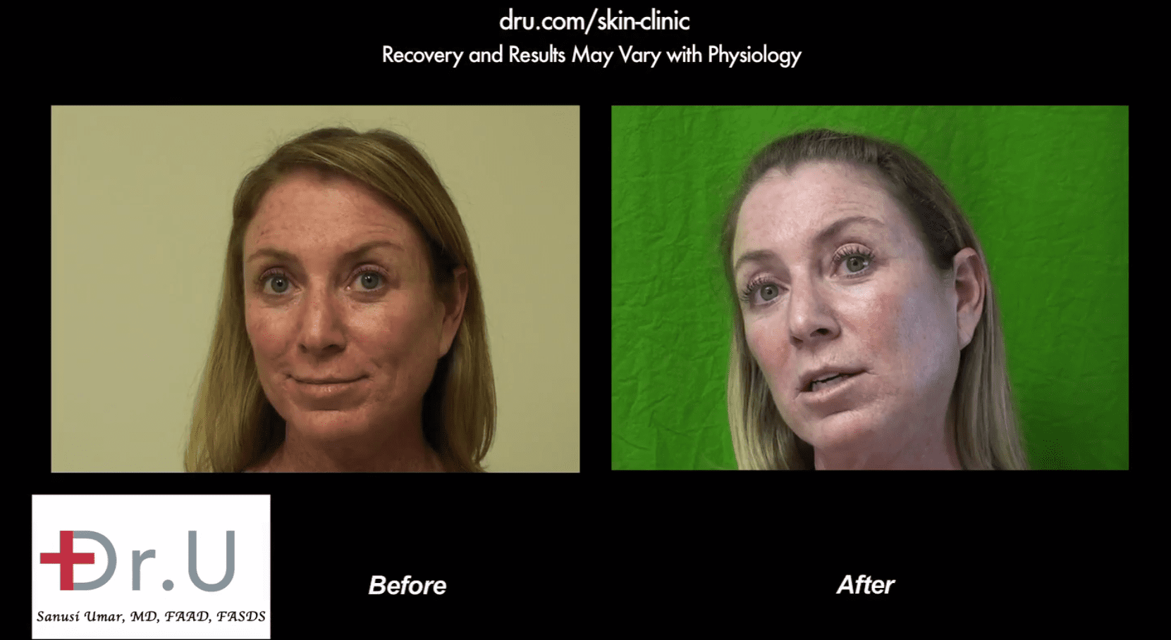 The spectra lazer (laser) results after a single session are already showing incredible improvement.* The spectra lazer (laser) results after a single session are already showing incredible improvement.*