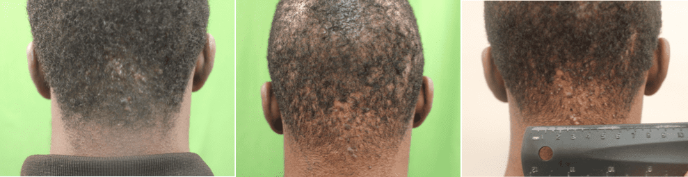 Steroid creams and solutions as AKN non surgical treatment are not a long term solutions and are typically partial.*