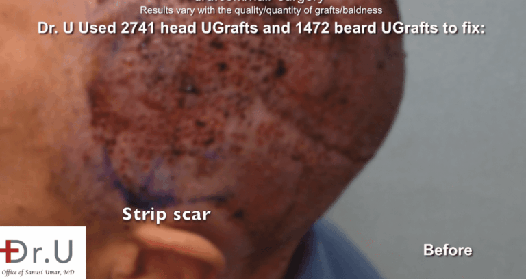 Dr. U harvests UGrafts from both the head and body donor areas in this bad hair transplant repair. 