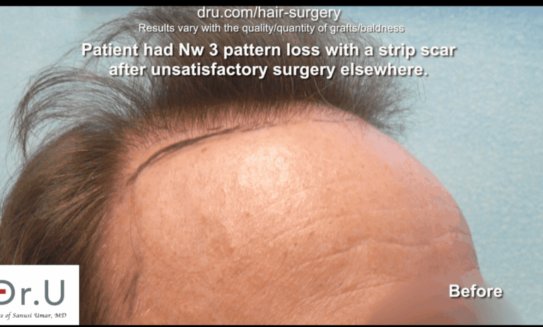 Norwood 3 patient before Dr. U hairline and strip scar repair.