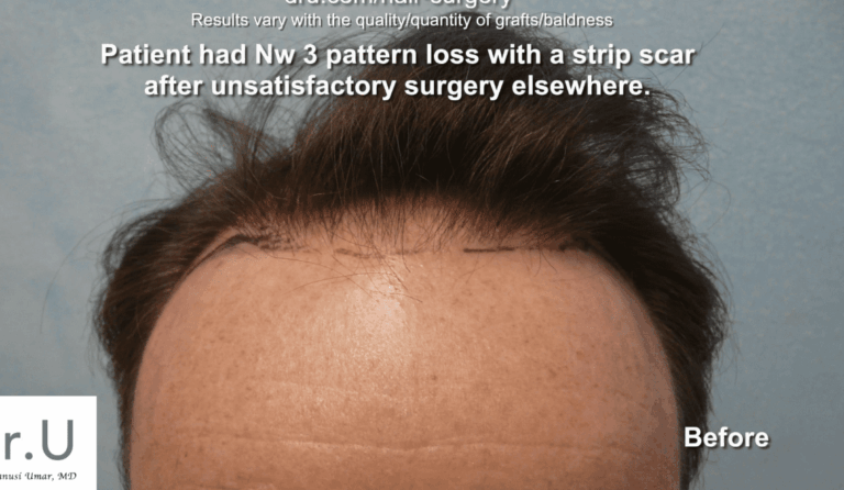 This Studio City patient wants to get rid of a hair transplant scar from a FUSS surgery performed at a different clinic.