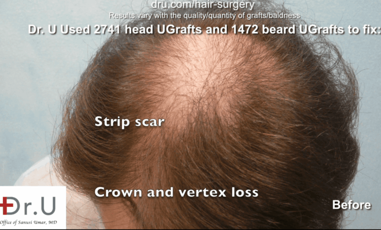 In addition to restoring crown hair loss, this patient wants to get rid of a hair transplant scar. 