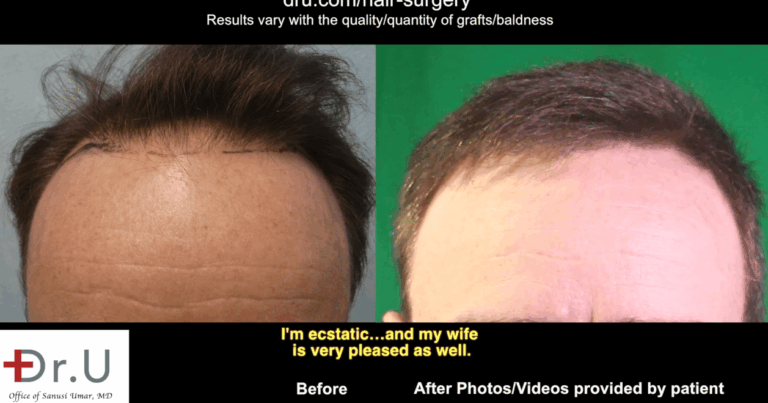  In order to restore and refine the hairline in his Studio City patient, Dr. Umar harvested donor hair from both the head and body.
