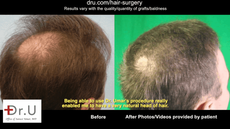 Using UGraft technology, Dr. Umar was able to get rid of a hair transplant scar by providing more coverage where the patient desired