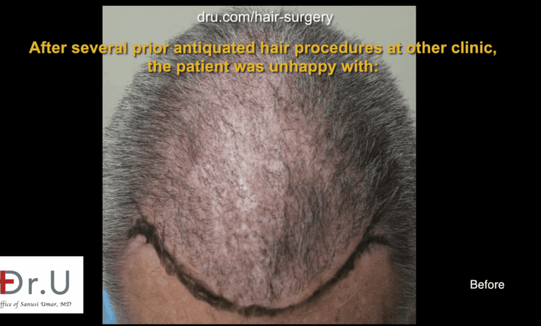 Due to the common misconception that older procedures are more reliable, individuals such as the patient above are faced with the problem of repairing older hair restorations results. 