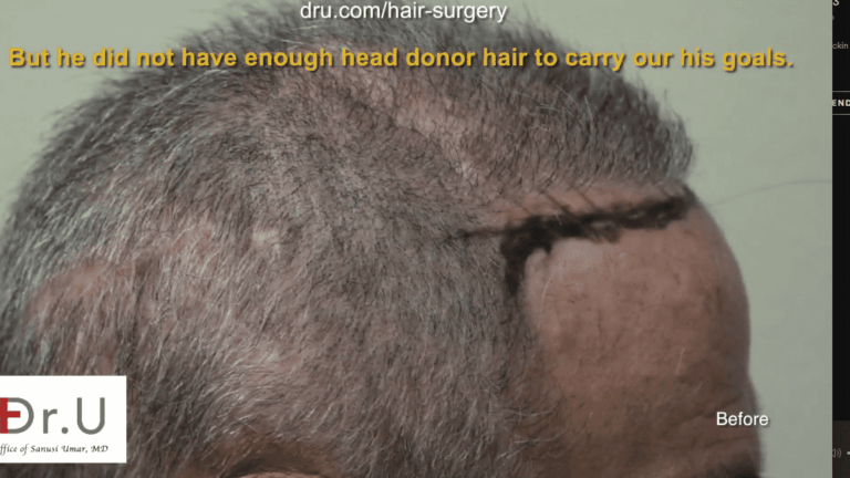 The patient was unhappy with the results from other outdated procedures, like hair plugs, but his depleted head hair donor supply prevented him from seeking other options.