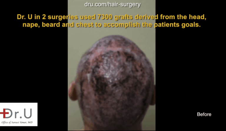 While other clinics might have turned this Newport Beach man away due to insufficient donor hair on the head, Dr. U used an advanced BHT FUE system to provide more grafts to reduce the appearance of hair plugs and scars from other surgeries. 
