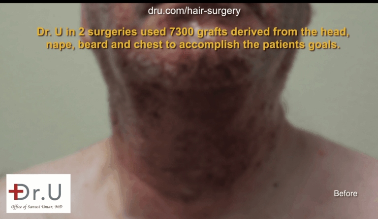 Dr. U harvested hair from the head, nape, beard and chest to expand the donor pool until sufficient grafts were available for a hair surgery correction. 