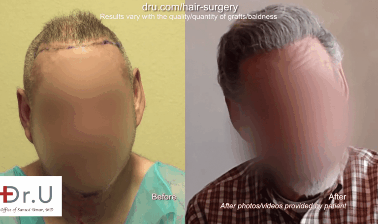 Instead of living unhappily with the results of outdated hair restoration procedures, this patient researched the best corrective hair surgery available and achieved the coverage he wanted.