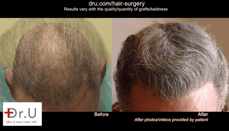 Since the patient's donor hair area was depleted from previous scalp reductions and outdated procedures, Dr. Umar extracted body hair with the Dr.UPunch Rotor to ensure a high body hair transplant success rate.