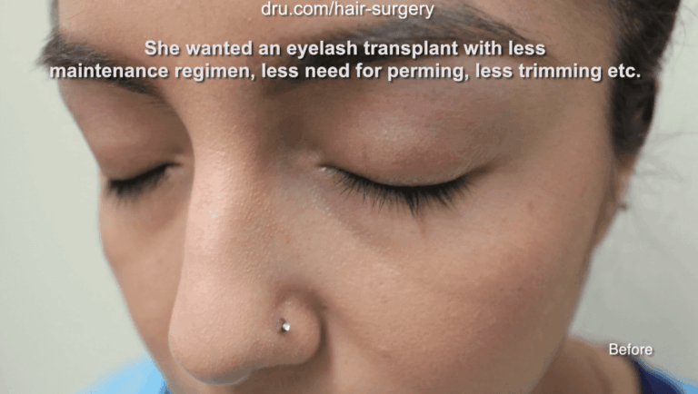 Before surgical eyelash implants with Dr. U. Before surgical eyelash implants with Dr. U.