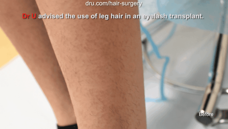 Leg hair grafts used to help the patient get longer lashes. Leg hair grafts used to help the patient get longer lashes.