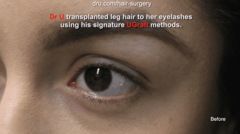 Dr.UGraf Surgical eyelash implants. Patient shown right before her procedure for Dr.UGraft surgical eyelash implants.