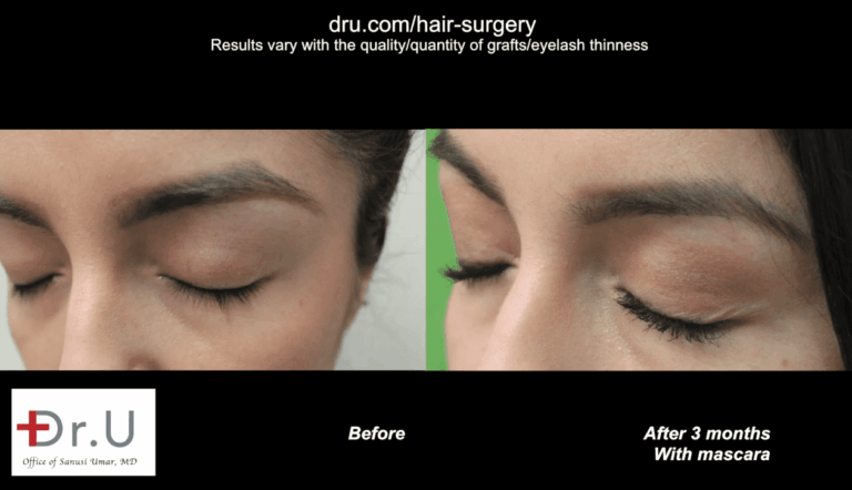 Fuller and longer surgical eyelash implants.* Fuller and longer surgical eyelash implants.*