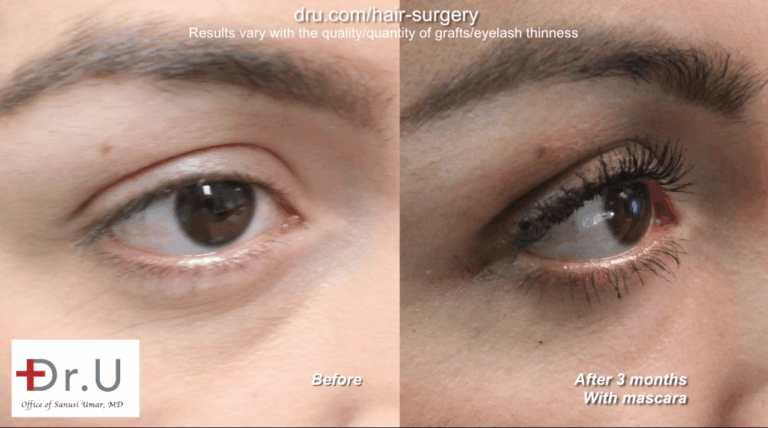 Before and after eyelash regrowth with Dr.UGraft using leg hair follicles.*. Before and after eyelash restoration with Dr.UGraft.