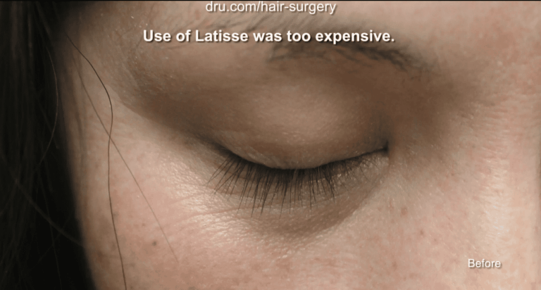 The patient wanted to see permanent growth from new eyelash treatments available, so she chose to receive an eyelash BHT from Dr. U. 