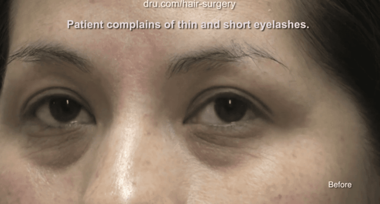After finding them too difficult to apply and maintain, this Venice Beach patient began to look for an alternative to eyelash extensions.