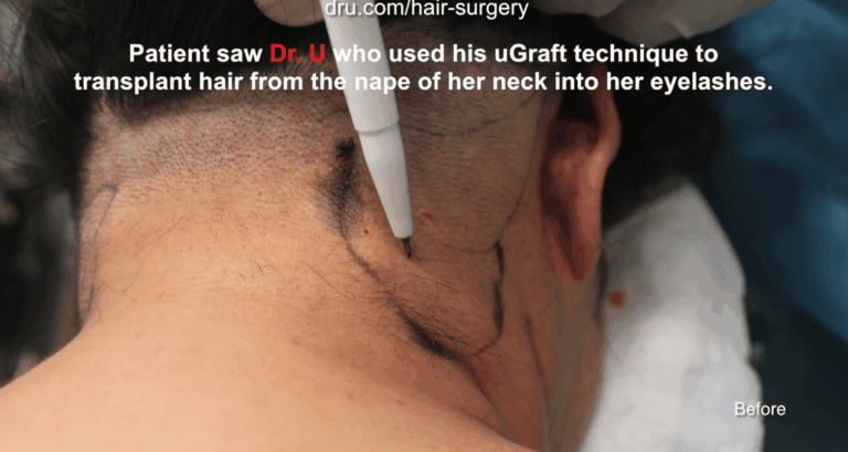 With the use of the Dr.UPunch Rotor ™, Dr. U can extract the fine, thin hairs on the nape of the neck, which will result in longer, natural eyelashes after surgery. 