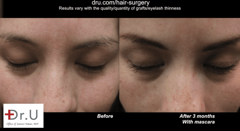 Three months after surgery, the patient's decision to find an alternative to eyelash extensions has paid off in the form of natural, permanent growth
