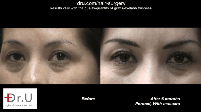 Dr. U fulfilled the patient's wish to get longer eyelashes by harvesting hairs from the nape of the neck, which are naturally thinner and more closely resemble eyelash hairs.