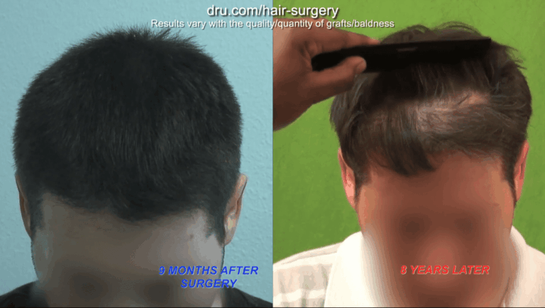 When you seek a hair transplant in your 20s, the natural progression of hair loss can be expected to manifest