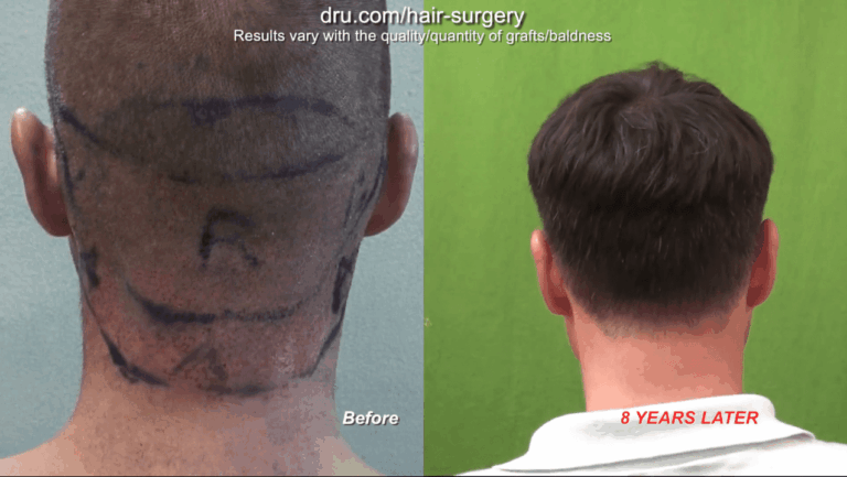 Getting a hair transplant in your 20s will most likely require future surgery in later years