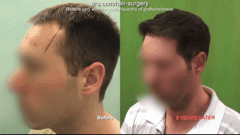 Planning your hair restoration at a young age requires anticipating future surgeries
