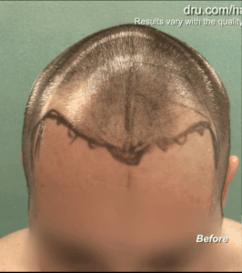 Patient shown right before his first FUE hairline revision eight years prior