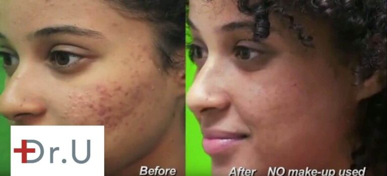 A laser acne scar treatment creates new collagen to improve the skin's texture