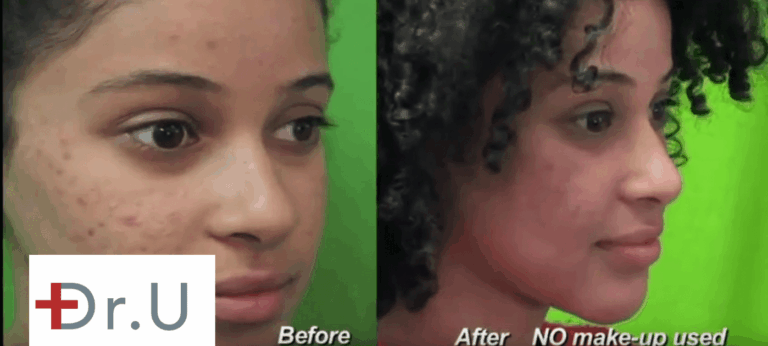 Patient opted for treating acne scars with Fraxel Dual - before and after photos