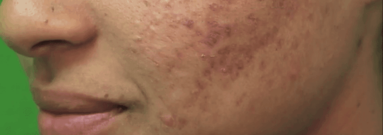 Patient who wants to improve acne scars on her face