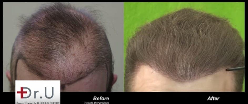 This hair repair patient of Dr. U benefited from 6500 grafts derived from the beard, scalp, nape and chest. The patient felt that his hair transplant cost was completely worth the expenditure This hair repair patient of Dr. U benefited from 6500 grafts derived from the beard, scalp, nape and chest. The patient felt that his hair transplant cost was completely worth the expenditure