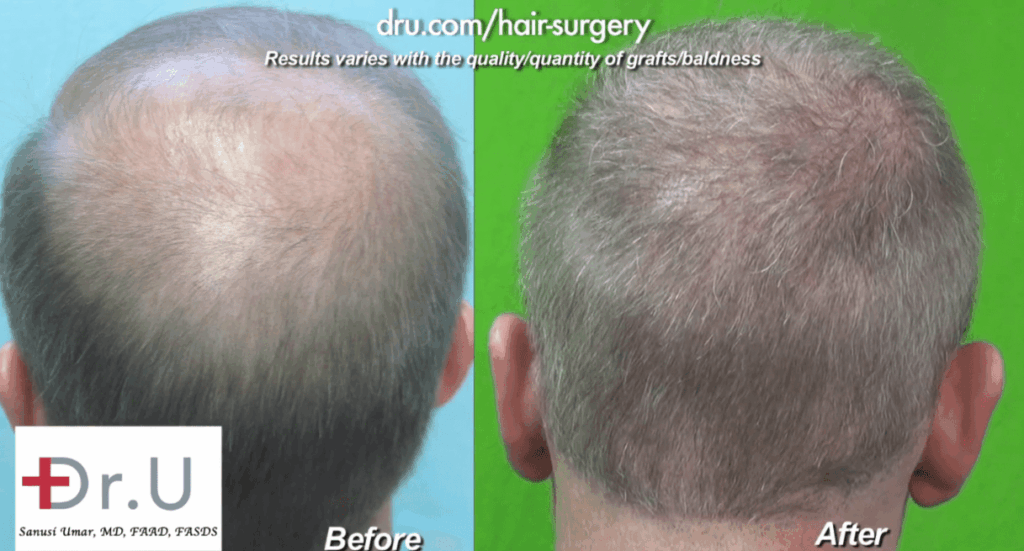 View of Crown for Norwood 6 before and after Dr.UGraft Surgery*