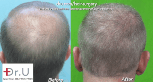 View of Crown for Norwood 6 before and after Dr.UGraft Surgery*