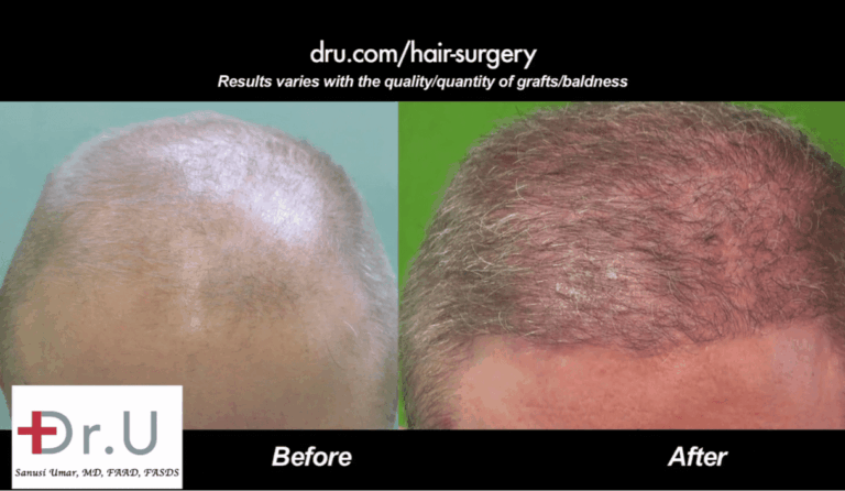 Hairline restoration for Norwood 6 Before and After Dr.UGraft