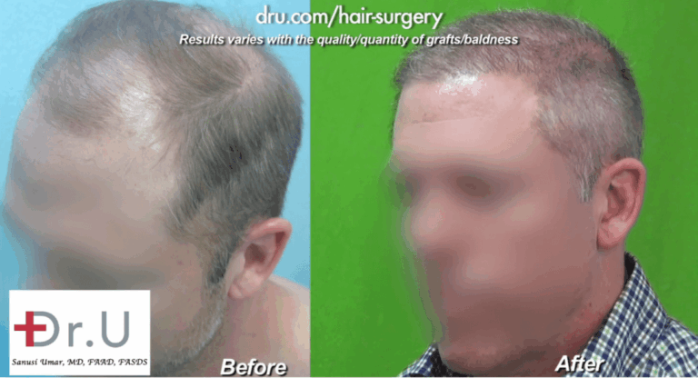 Three Quarters View of NW 6 Hair Transplant Using Dr.UGraft