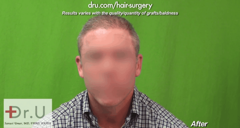 Front view of Norwood 6 FUE results after Dr.UGraft