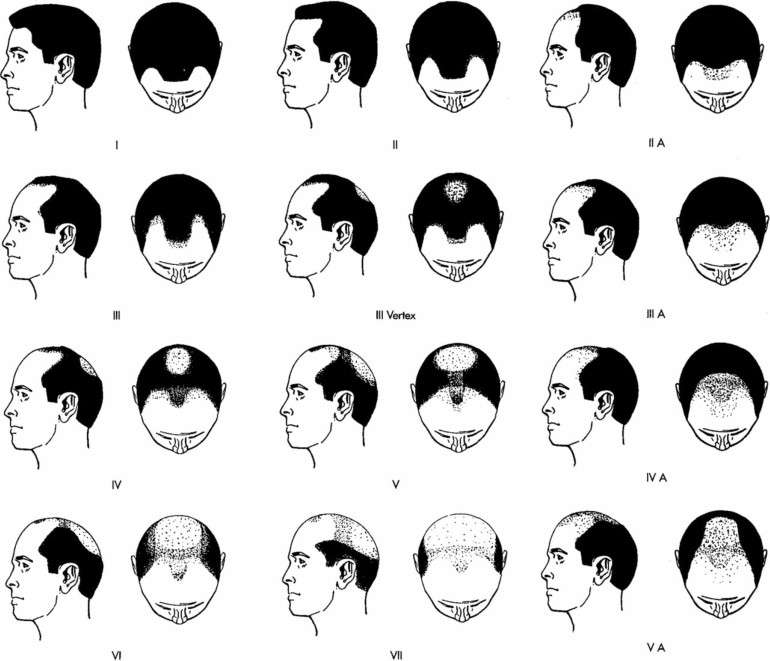 The Norwood Scale can help evaluate different types of hairlines as hair loss progresses.*