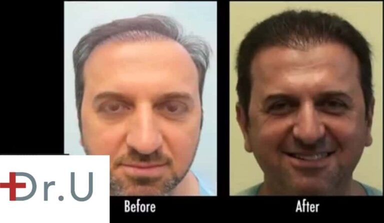 Front view of temple point hair transplant and full restoration After several botched hair transplants, this patient sought out Dr. Umar for a temple hair restoration. Dr. Umar's advanced FUE Dr.UGraft system allowed him to expand the patient's donor pool in order to create a natural hairline and cover his strip scars.