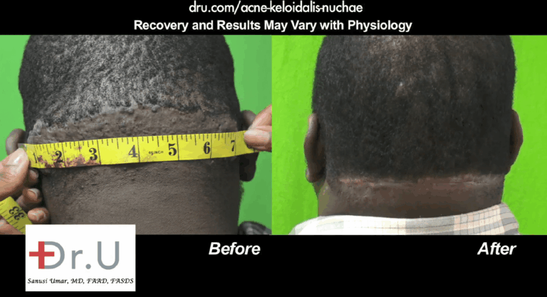 A medical dermatologist should be able to perform specialized surgeries, like this AKN removal at Dr.U Skin Clinic.