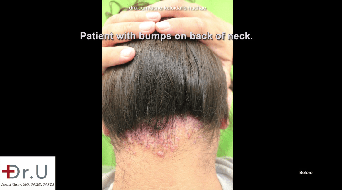 Before his AKN removal operation, the patient suffered AKN pimples on the back of the scalp for 12 years.* Before his AKN removal operation, the patient suffered AKN pimples on the back of the scalp for 12 years.*