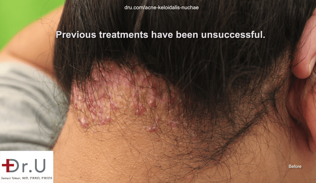Prior to his AKN removal operation the patient sought help for large bumps at the base of the neck.* Prior to his AKN removal operation the patient sought help for large bumps at the base of the neck.*