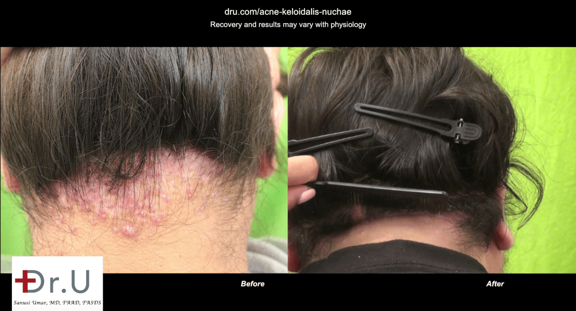 Before and after AKN removal operation; Dr. Umar was the AKN doctor this patient was seeking.* Before and after AKN removal operation; Dr. Umar was the AKN doctor this patient was seeking.*