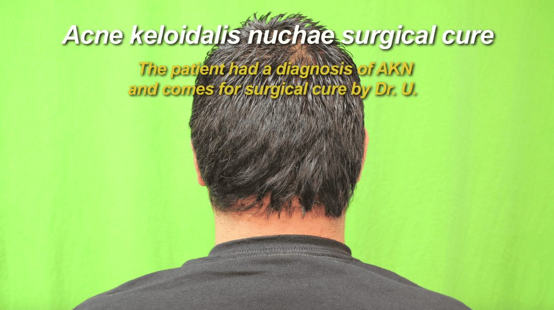 This patient wore his hair long to cover the disease while he sought a way to get rid of AKN.*